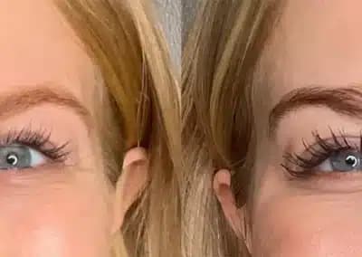botox crows feet before and after photos by awskinco+ in murfreesboro tn