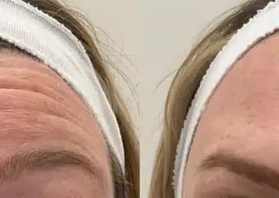 botox forehead before and after photos by awskinco+ in murfreesboro tn