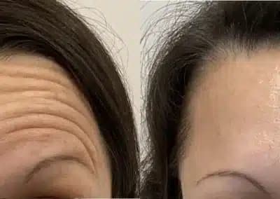 botox forehead before and after photos by awskinco+ in murfreesboro tn