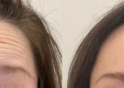 botox forehead before and after photos by awskinco+ in murfreesboro tn