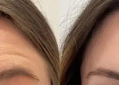 botox forehead before and after photos by awskinco+ in murfreesboro tn
