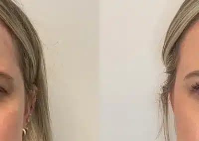 botox glabella before and after photos by awskinco+ in murfreesboro tn