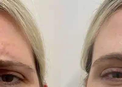 botox glabella before and after photos by awskinco+ in murfreesboro tn