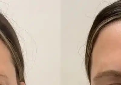 botox glabella before and after photos by awskinco+ in murfreesboro tn