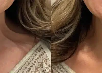 botox platysmal before and after photos by awskinco+ in murfreesboro tn