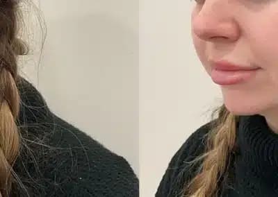 jawline filler before and after photos by awskinco+ in murfreesboro tn