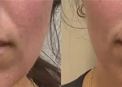 lips fillers before and after photos by awskinco+ in murfreesboro tn