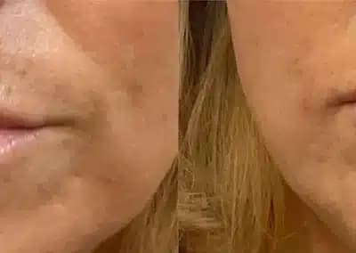 lips fillers before and after photos by awskinco+ in murfreesboro tn
