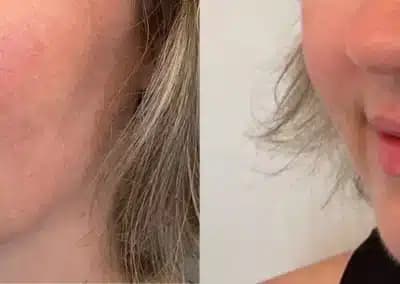 lips fillers before and after photos by awskinco+ in murfreesboro tn