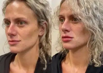 lips fillers before and after photos by awskinco+ in murfreesboro tn