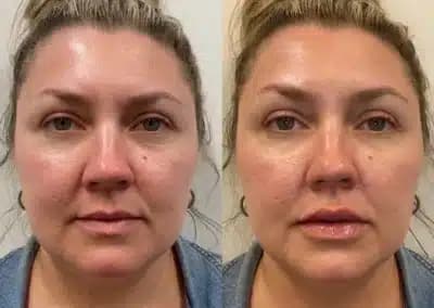 lips fillers before and after photos by awskinco+ in murfreesboro tn