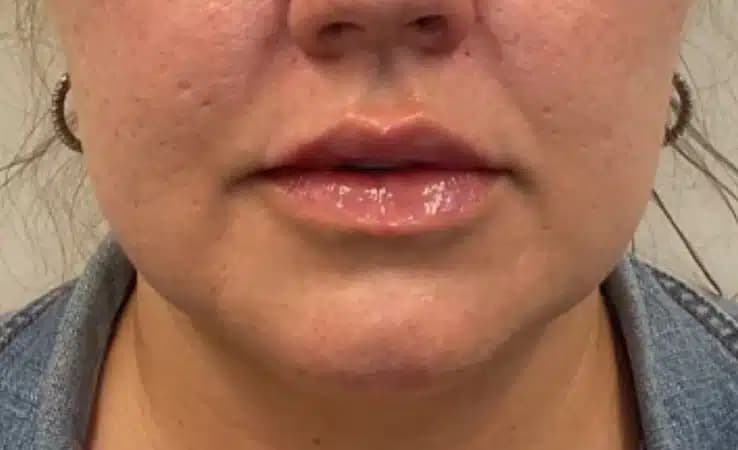 After Results of a AWSkinCo+ patient that received Dermal Filler treatment on their lips.