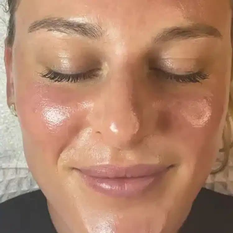 After Results of a AWSkinCo+ patient that received Hydrafacial treatment on their face.