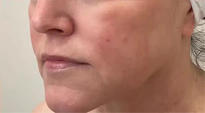 After Results of a AWSkinCo+ patient that received IPL Laser Results treatment on their face.