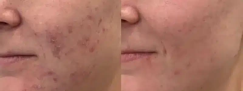 chemical peels at awskinco before and after results