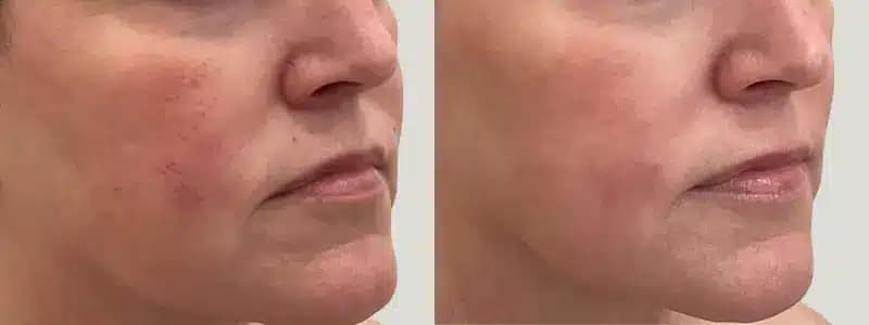 ipl at awskinco before and after results