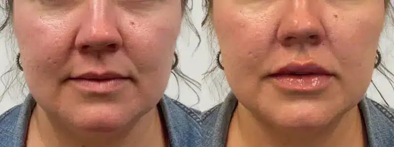 lip filler at awskinco before and after results