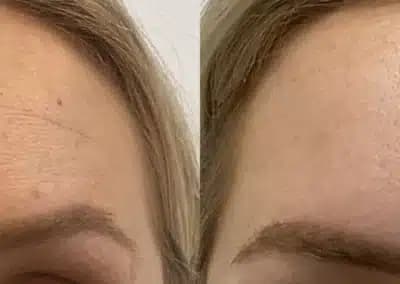 front view botox before and after photos by awskinco