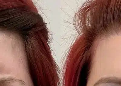 front view botox before and after photos by awskinco pt