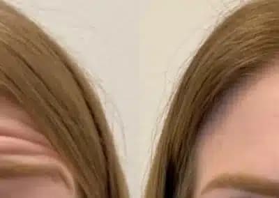 front view botox before and after photos by awskinco pt