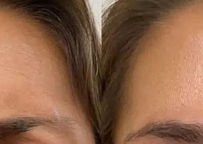 front view botox before and after photos by awskinco pt