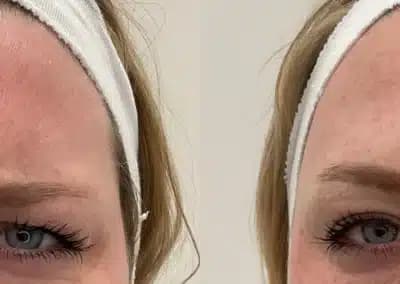 front view botox before and after photos by awskinco pt