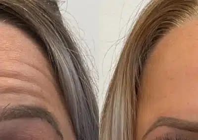 front view botox before and after photos by awskinco pt