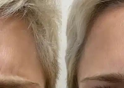 front view botox before and after photos by awskinco pt