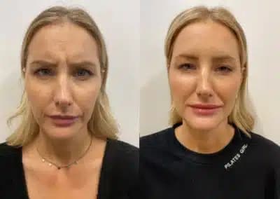 front view botox before and after photos by awskinco pt