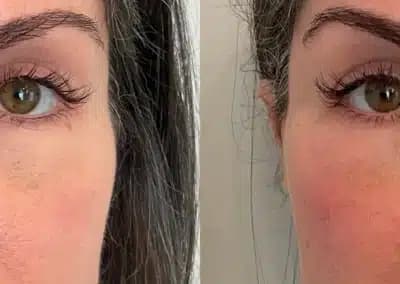 front view cheek filler before and after photos by awskinco pt