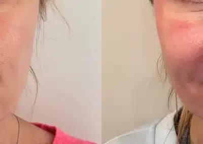 front view cheek filler before and after photos by awskinco pt