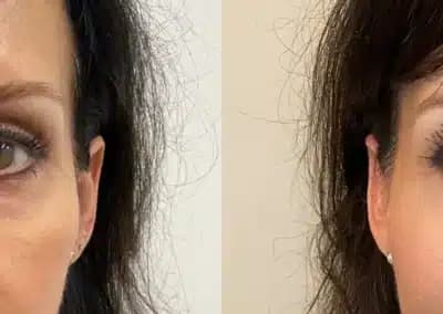 front view cheek filler before and after photos by awskinco pt