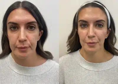 front view cheek filler before and after photos by awskinco pt