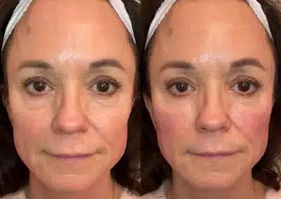 front view cheek filler before and after photos by awskinco pt