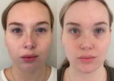 front view full face filler before and after photos by awskinco pt