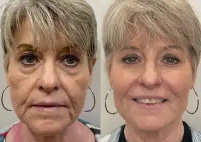 front view full face filler before and after photos by awskinco pt