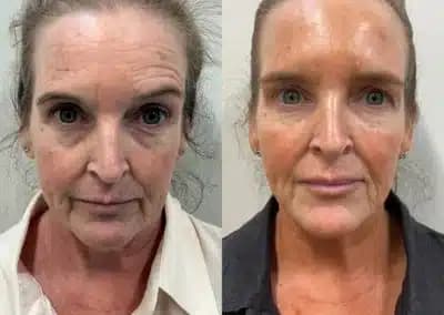 front view full face filler before and after photos by awskinco pt
