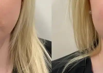 front view lip filler before and after photos by awskinco pt