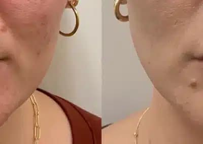 front view lip filler before and after photos by awskinco pt