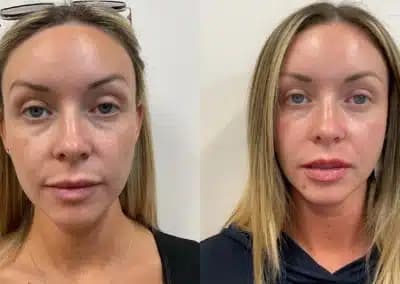 front view lip filler before and after photos by awskinco pt