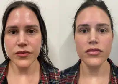 front view lip filler before and after photos by awskinco pt