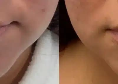 front view lip filler before and after photos by awskinco pt