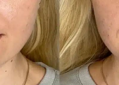 front view lip filler before and after photos by awskinco pt