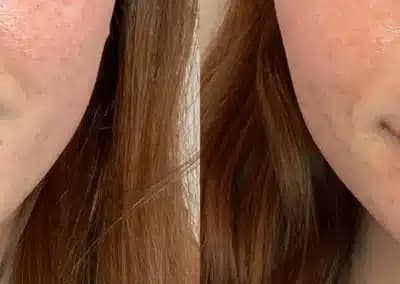 front view lip filler before and after photos by awskinco pt