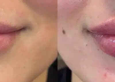 front view lip filler before and after photos by awskinco pt