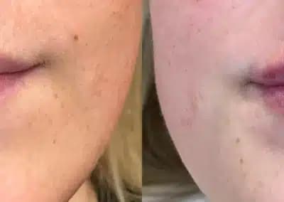 front view lip filler before and after photos by awskinco pt