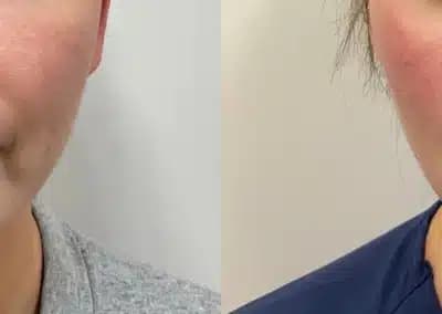 front view lower face filler before and after photos by awskinco pt