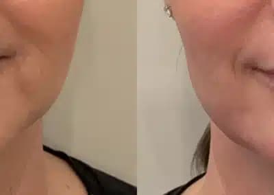 front view lower face filler before and after photos by awskinco pt