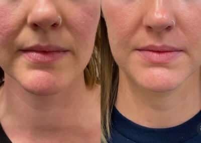 front view microneedling before and after photos by awskinco