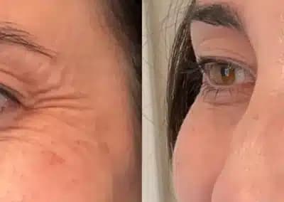 left oblique view botox before and after photos by awskinco pt